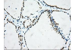 Immunohistochemical staining of paraffin-embedded Adenocarcinoma of Human colon tissue using anti-USP5 mouse monoclonal antibody.