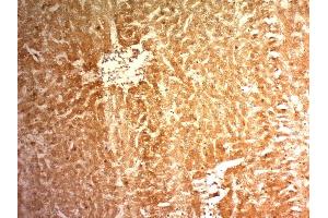 Formalin-fixed, paraffin-embedded human Hepatocellular Carcinoma (HCC) stained with Glypican-3 Monoclonal Antibody (1G12) (Glypican 3 antibody  (AA 511-580))
