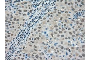 Immunohistochemical staining of paraffin-embedded Adenocarcinoma of colon tissue using anti-LDHAmouse monoclonal antibody. (Lactate Dehydrogenase A antibody)