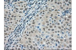 Immunohistochemical staining of paraffin-embedded Adenocarcinoma of colon tissue using anti-LDHAmouse monoclonal antibody.