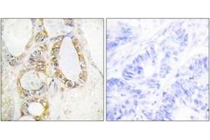 Immunohistochemistry analysis of paraffin-embedded human colon carcinoma tissue, using MUC13 Antibody. (MUC13 antibody  (AA 421-470))