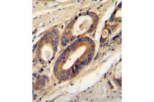 ATP6V0B Antibody (Center) (ABIN654391 and ABIN2844135) immunohistochemistry analysis in formalin fixed and paraffin embedded human prostate carcinoma followed by peroxidase conjugation of the secondary antibody and DAB staining. (ATP6V0B antibody  (AA 104-131))