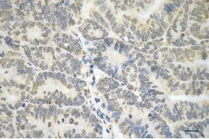 Immunohistochemistry was performed on paraffin-embedded human endometrial carcinoma using vimentin antibody (ABIN7800836), 1:100).