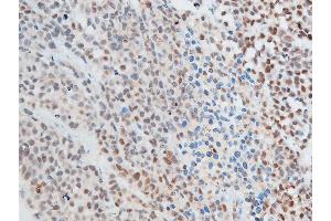 ABIN6267250 at 1/100 staining rat cancer tissue sections by IHC-P. (CHEK2 antibody  (pThr387))