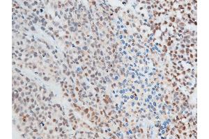 ABIN6267250 at 1/100 staining rat cancer tissue sections by IHC-P. (CHEK2 antibody  (pThr387))
