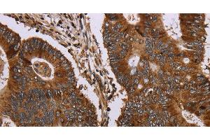 Immunohistochemistry of paraffin-embedded Human colon cancer tissue using MAGEC2 Polyclonal Antibody at dilution 1:40 (MAGEC2 antibody)