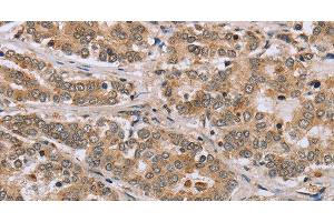 Immunohistochemistry of paraffin-embedded Human liver cancer tissue using CLEC16A Polyclonal Antibody at dilution 1:45 (CLEC16A antibody)