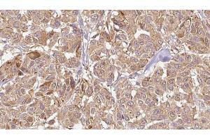 ABIN6276489 at 1/100 staining Human Melanoma tissue by IHC-P. (GPX5 antibody  (Internal Region))