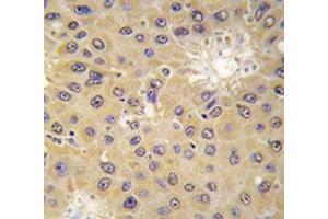 IHC analysis of FFPE human hepatocarcinoma tissue stained with ACAT1 antibody (ACAT1 antibody  (AA 296-329))