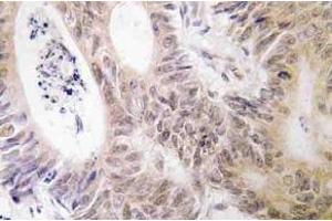 Immunohistochemistry (IHC) analyzes of MSK1 antibody in paraffin-embedded human colon carcinoma tissue. (MSK1 antibody)