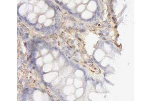 ABIN6266830 at 1/100 staining human colon cancer tissues sections by IHC-P.