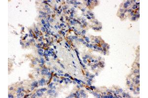 Anti-CYP27B1 Picoband antibody, IHC(P) IHC(P): Human Kidney Cancer Tissue (CYP27B1 antibody  (C-Term))