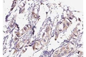 ABIN6276448 at 1/100 staining Human breast cancer tissue by IHC-P. (TLR1 antibody  (Internal Region))