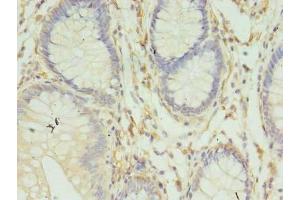 Immunohistochemistry of paraffin-embedded human colon cancer using ABIN7155609 at dilution of 1:100 (HLA-DRB4 antibody  (AA 30-227))