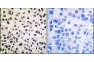 Immunohistochemistry analysis of paraffin-embedded human breast carcinoma, using MEF2A (Phospho-Ser408) Antibody. (MEF2A antibody  (pSer408))