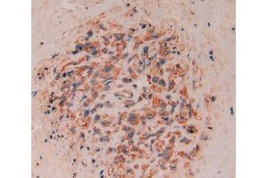 Used in DAB staining on fromalin fixed paraffin- embedded lung cancer tissue (CD8B antibody  (AA 22-170))