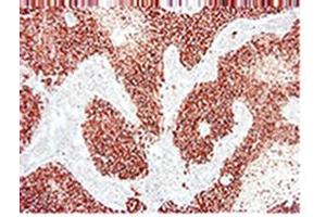 Immunohistochemistry on paraffin section of human breast carcinoma