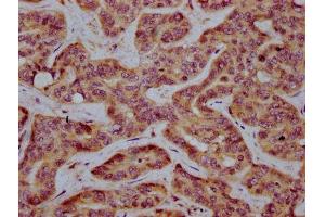 IHC image of ABIN7155184 diluted at 1:400 and staining in paraffin-embedded human liver cancer performed on a Leica BondTM system. (MS4A2 antibody  (AA 1-59))