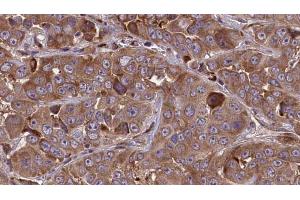 ABIN6273842 at 1/100 staining Human liver cancer tissue by IHC-P. (CMKLR1 antibody  (Internal Region))