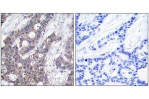 Immunohistochemical analysis of paraffin-embedded human breast carcinoma tissue using Stathmin 1(Phospho-Ser16) Antibody(left) or the same antibody preincubated with blocking peptide(right). (Stathmin 1 antibody  (pSer16))