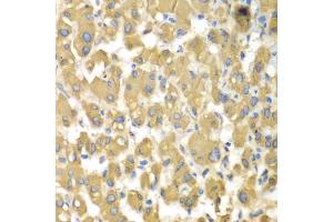 Immunohistochemistry of paraffin-embedded human liver injury using MAP4K3 antibody (ABIN5975507) at dilution of 1/100 (40x lens). (MAP4K3 antibody)