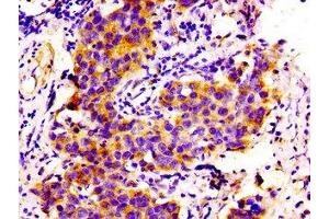 Immunohistochemistry of paraffin-embedded human bladder cancer using ABIN7148247 at dilution of 1:100 (COL6A2 antibody  (AA 254-400))