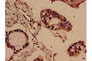Immunohistochemistry analysis of human pancreatic cancer using ABIN7151520 at dilution of 1:100 (EVC antibody  (AA 493-602))