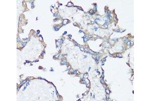Immunohistochemistry of paraffin-embedded Human lung cancer using SRC Polyclonal Antibody at dilution of 1:100 (40x lens). (Src antibody)