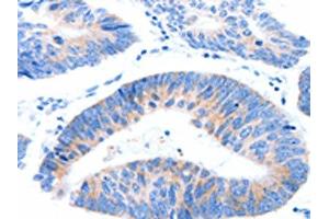 The image on the left is immunohistochemistry of paraffin-embedded Human colon cancer tissue using ABIN7191546(MUC3A Antibody) at dilution 1/60, on the right is treated with synthetic peptide. (MUC3A antibody)