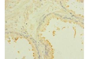 Immunohistochemistry of paraffin-embedded human prostate cancer using ABIN7168444 at dilution of 1:100