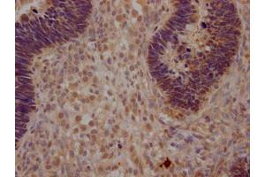 IHC image of ABIN7172750 diluted at 1:200 and staining in paraffin-embedded human ovarian cancer performed on a Leica BondTM system. (YAP1 antibody  (AA 155-504))