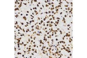 Immunohistochemistry of paraffin-embedded human liver cancer using DiMethyl-Histone H3-K27 antibody. (Histone 3 antibody  (H3K27me))