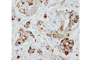 IHC-P: SKP2 antibody testing of human breast cancer tissue (SKP2 antibody  (N-Term))