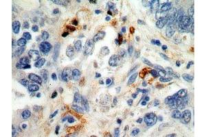 IHC analysis of paraffin-embedded human stomach cancer cells using S100A8 Antibody (dilution 1:100). (S100A8 antibody)