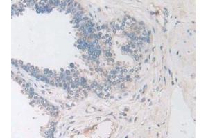 Detection of F8 in Human Prostate Tissue using Polyclonal Antibody to Coagulation Factor VIII (F8)