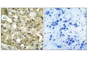Immunohistochemical analysis of paraffin- embedded human breast carcinoma tissue using V (VEGFR2/CD309 antibody)