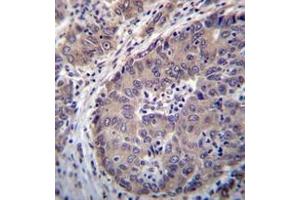 Immunohistochemistry analysis in formalin fixed and paraffin embedded human hepatocarcinoma reacted with PNLIPRP3 Antibody (N-term) followed which was peroxidase conjugated to the secondary antibody and followed byDAB staining. (PNLIPRP3 antibody  (N-Term))