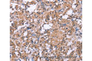Immunohistochemistry of Human gastric cancer using SLC52A1 Polyclonal Antibody at dilution of 1:40