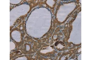 Immunohistochemistry of Human esophagus cancer using S100A6 Polyclonal Antibody at dilution of 1:35 (S100A6 antibody)