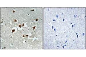 Immunohistochemistry analysis of paraffin-embedded human brain carcinoma tissue, using AFX (Ab-197) Antibody. (FOXO4 antibody  (AA 164-213))
