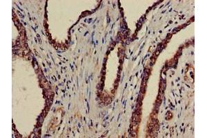 Immunohistochemistry of paraffin-embedded human prostate cancer using ABIN7145034 at dilution of 1:100 (ATAD1 antibody  (AA 289-350))