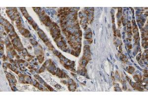 ABIN6267165 at 1/100 staining Human thyroid cancer tissue by IHC-P. (DLG4 antibody  (pTyr236, pTyr240))