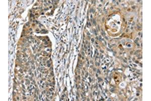 The image on the left is immunohistochemistry of paraffin-embedded Human esophagus cancer tissue using ABIN7130610(PHLPP1 Antibody) at dilution 1/35, on the right is treated with fusion protein.