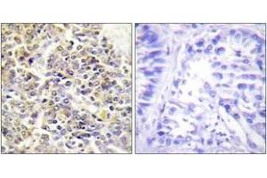 Immunohistochemistry analysis of paraffin-embedded human lung carcinoma tissue, using ASC Antibody. (STS antibody  (AA 10-59))