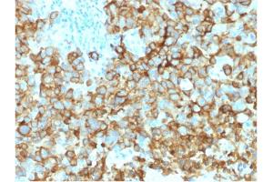 Formalin-fixed, paraffin-embedded human Melanoma stained with gp100 Mouse Monoclonal Antibody (PMEL/2039).