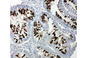 IHC-P: p107 antibody testing of human intestinal cancer tissue