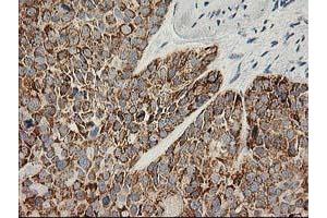 Immunohistochemical staining of paraffin-embedded Adenocarcinoma of Human breast tissue using anti-AK4 mouse monoclonal antibody. (AK4 antibody)