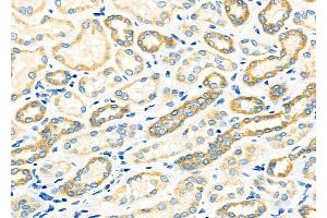 ABIN6265577 and ABIN6273331 at 1/100 staining Human kidney cancer and adjacent normal tissues by IHC-P.