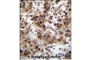 ZN Antibody (N-term) (ABIN655359 and ABIN2844918) immunohistochemistry analysis in formalin fixed and paraffin embedded human breast carcinoma followed by peroxidase conjugation of the secondary antibody and DAB staining. (ZNF321P antibody  (N-Term))