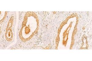 Immunohistochemistry of paraffin-embedded Human breast cancer tissue using ZNF580 Polyclonal Antibody at dilution of 1:40(x200) (ZNF580 antibody)